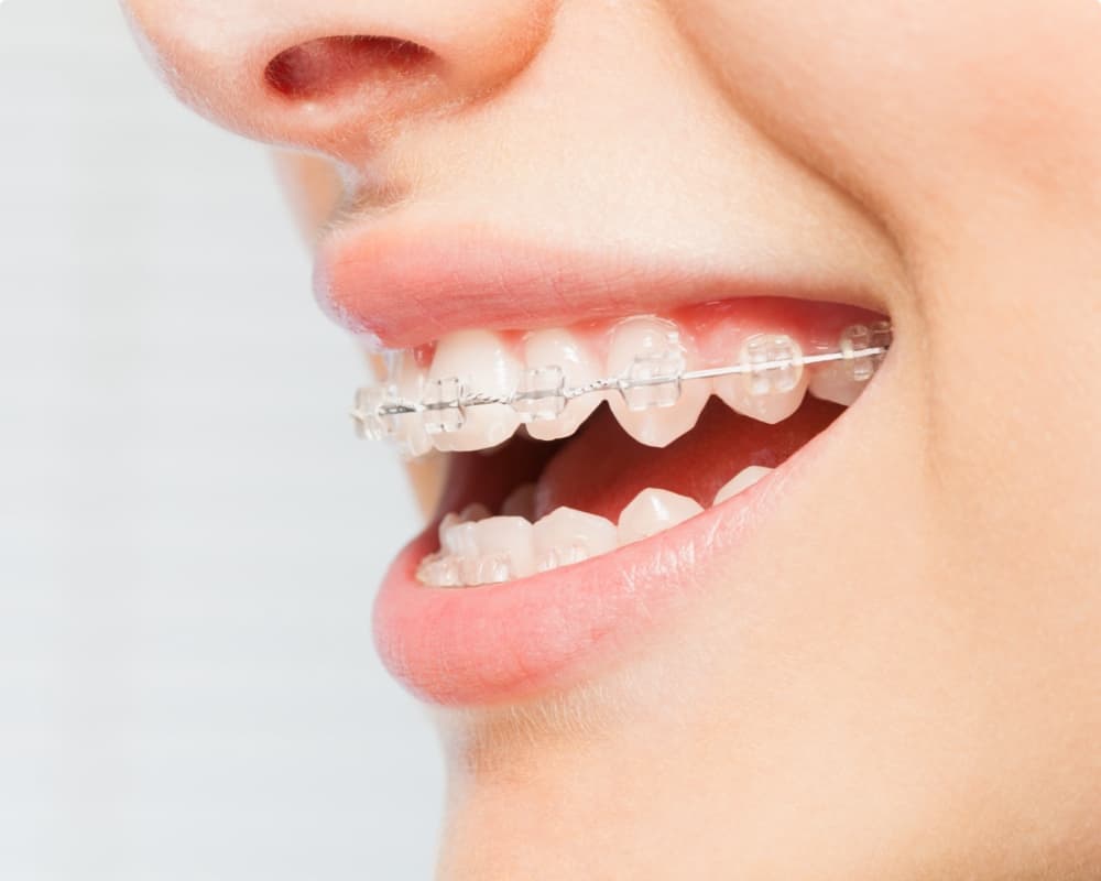 adult patient wearing clear braces