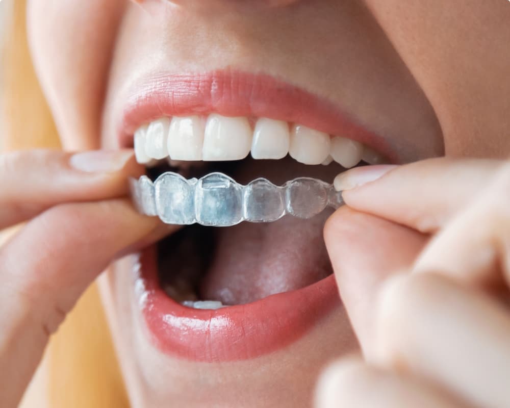 adult patient wearing invisalign