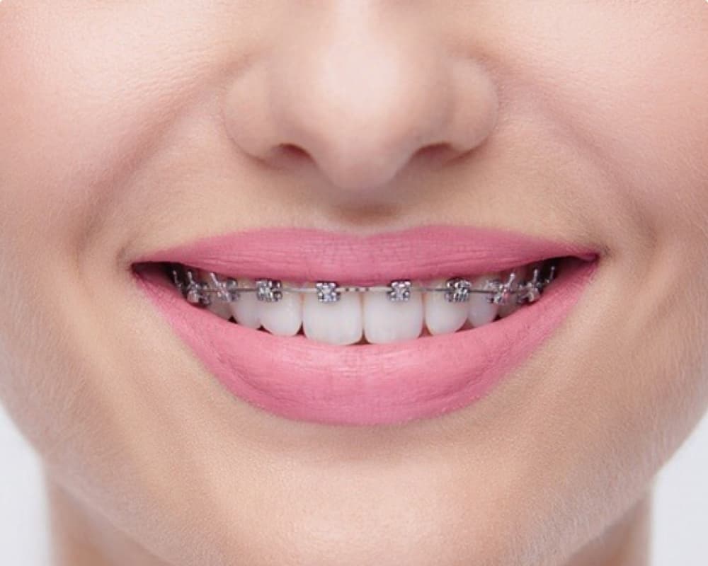adult patient wearing metal braces