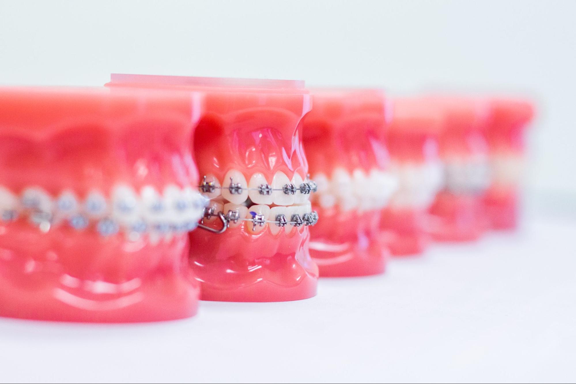 Orthodontic FAQs